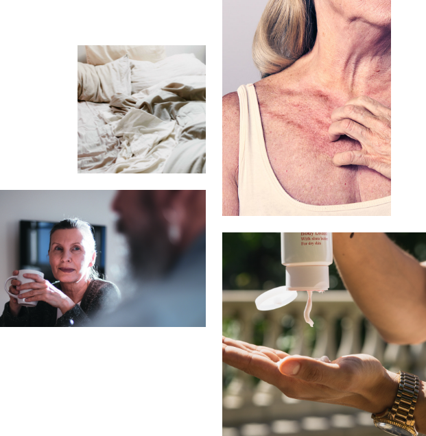 A collage of four pictures showcasing a woman holding a hot drink, a woman in a vest scratching her upper chest, an unmade, empty bed with a duvet and a close up of an outstretched hand which is having cream applied to it from a tube of held above.